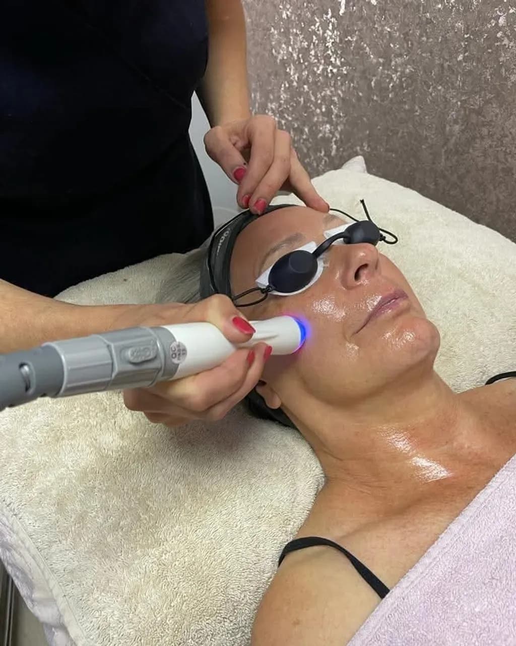 radio frequency facial tightnening
