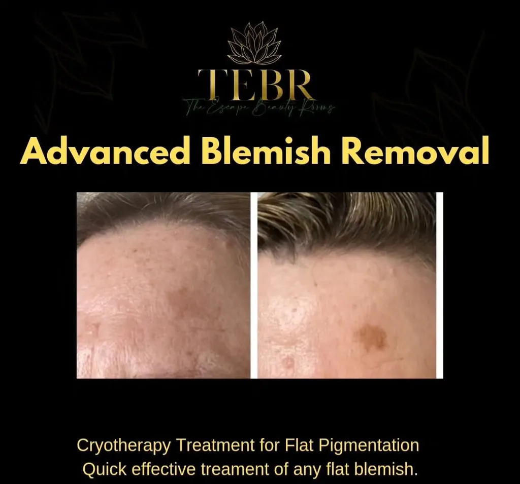 Advanced Blemish Removal